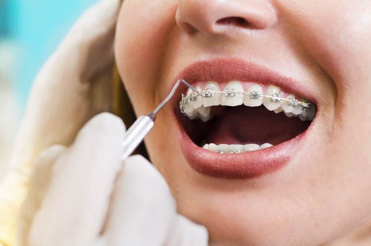 Traitement par aligneurs invisibles et orthodontie